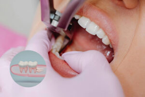 Tarkusehamba eemaldamine