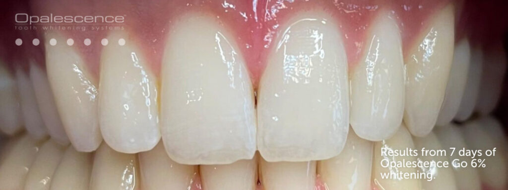 Hammaste valgendamine, pärast