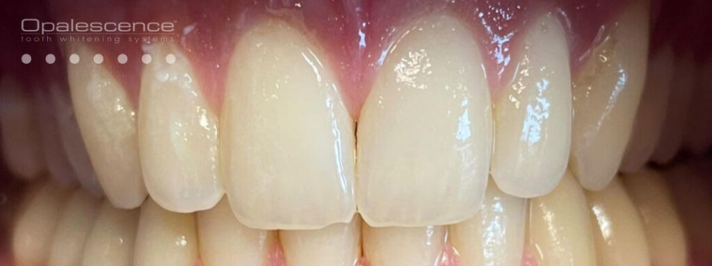 Hammaste valgendamine, enne